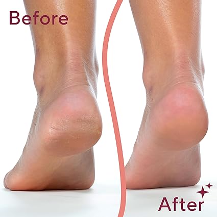 Electric Foot Callus Remover / Electric Pedicure Tool جهاز إزالة مسامير القدم الكهربائي