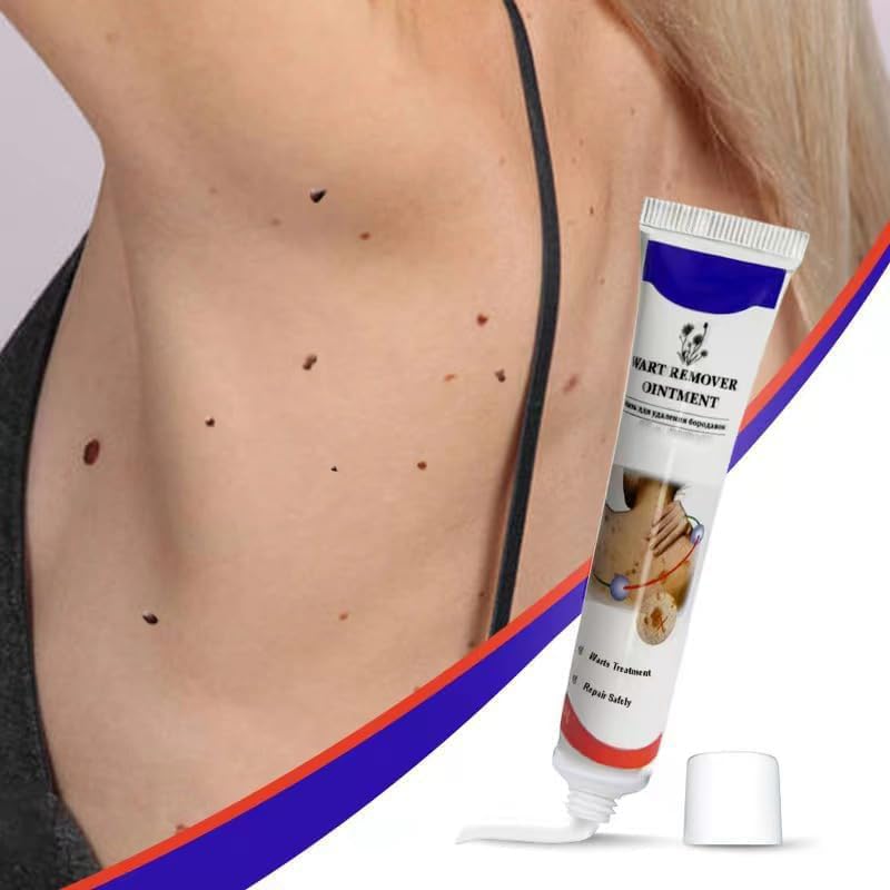 Warts Remover Ointment – مرهم إزالة الثآليل