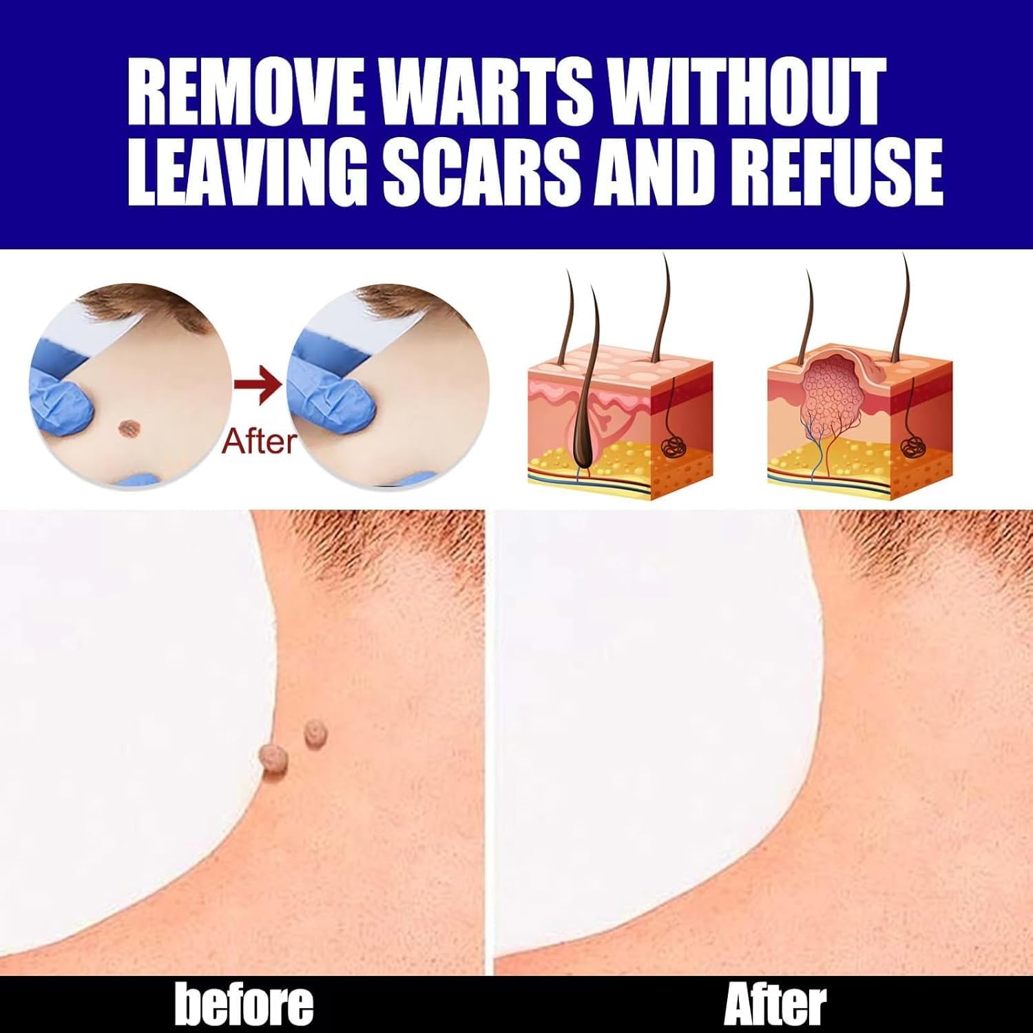 Warts Remover Ointment – مرهم إزالة الثآليل